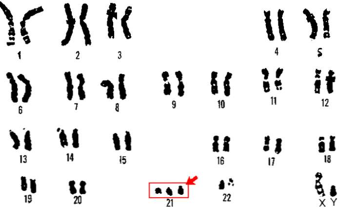 Синдром Дауна, трисомия и половые хромосомы