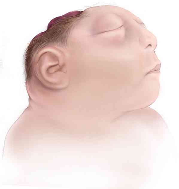 Anencephaly Symptomer, årsaker, behandlinger