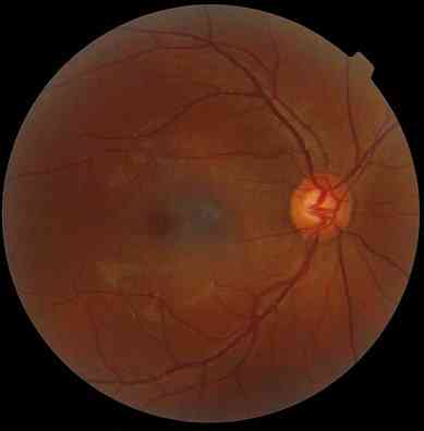 Gejala, Penyebab dan Perawatan Neuritis Optik