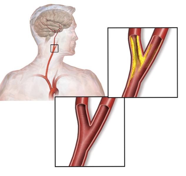 Co je to karotická stenóza?