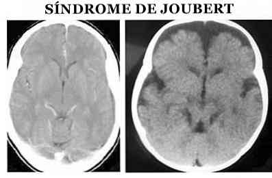 Simptomi Joubertovega sindroma, vzroki, zdravljenje
