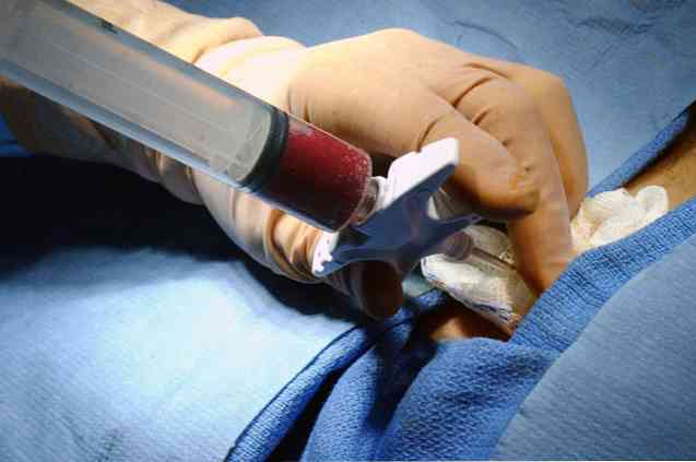 Marrow Transplant Typer og Hvordan Donere