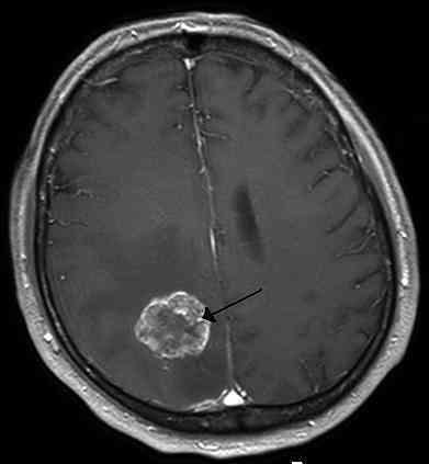Typy nádorů mozku, symptomy a příčiny
