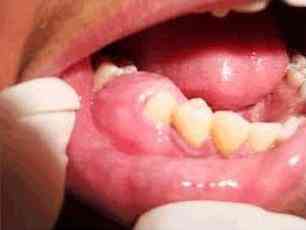 periodontális kezelés cukorbetegség