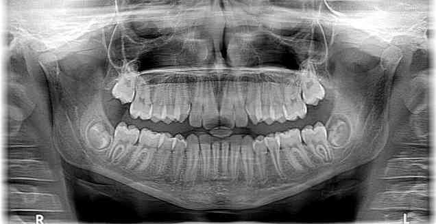 Торус нижней челюсти Симптомы, причины, лечение