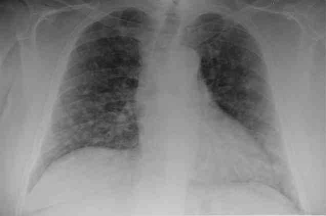 Аденопатия. Аденопатия кистозного характера. Hilio pulmonaris. Pulmonar Cancer with metastasis in Heart.