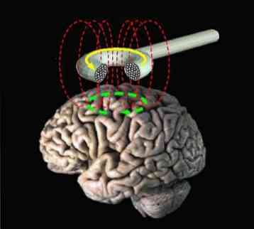 Transcranial magnetisk stimulering for hva den brukes, typer og patologier