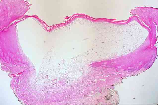 De 9 huvudtyperna av cyster