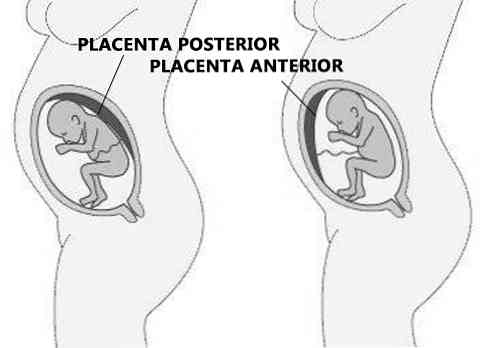 Kemungkinan akibat plasenta dan pencegahan posterior