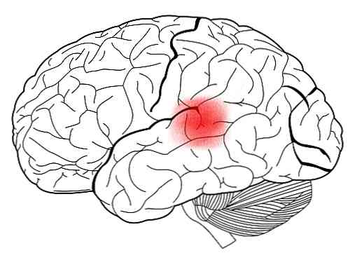 失語症者の運動皮質症状、原因および治療