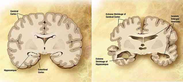 대뇌 피질 및 피질 위축증 증상, 원인 및 관여