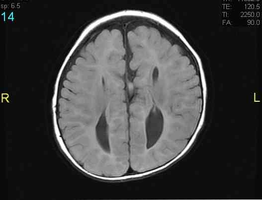 Colpocephaly Príznaky, príčiny a liečby