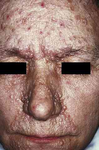 Triệu chứng Facomatosis, các loại và nguyên nhân