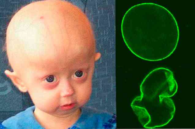 Progeria-tyypit, syyt, hoidot
