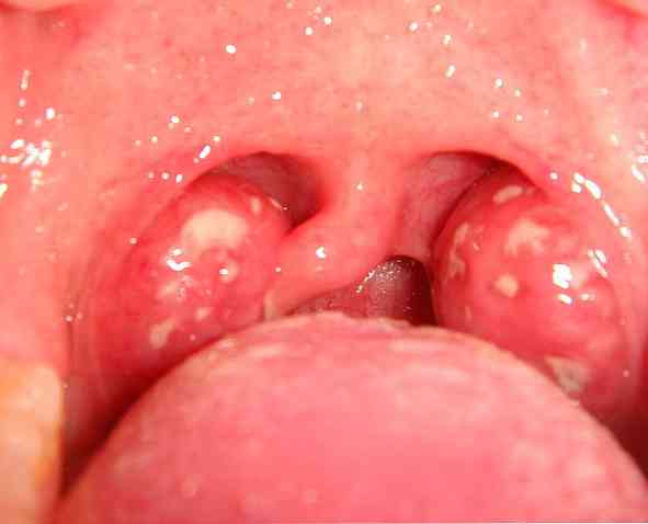 Pultiküler tonsillit nedir?