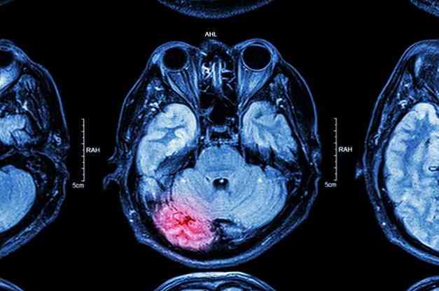 Hội chứng tiểu não Triệu chứng, nguyên nhân, điều trị